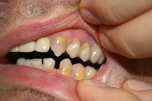 Speciality: a heavily discoloured dentition