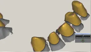 CAD/CAM tervezés a Zirkonzahn programban (5/23)