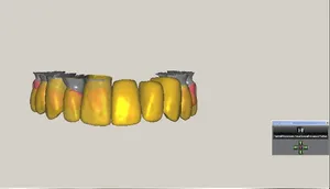 CAD/CAM tervezés a Zirkonzahn programban (7/23)