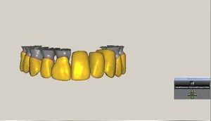 CAD/CAM tervezés a Zirkonzahn programban (8/23)