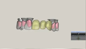 CAD/CAM tervezés a Zirkonzahn programban (9/23)