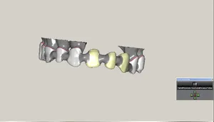 CAD/CAM tervezés a Zirkonzahn programban (10/23)