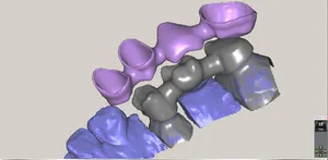 CAD/CAM tervezés a Zirkonzahn programban (12/23)