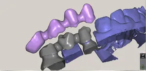 CAD/CAM tervezés a Zirkonzahn programban (13/23)