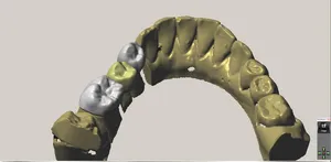 CAD/CAM tervezés a Zirkonzahn programban (15/23)