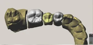 CAD/CAM tervezés a Zirkonzahn programban (16/23)
