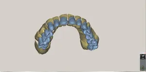 CAD/CAM tervezés a Zirkonzahn programban (19/23)