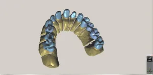 CAD/CAM tervezés a Zirkonzahn programban (20/23)