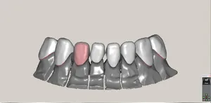 CAD/CAM tervezés a Zirkonzahn programban (22/23)