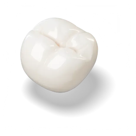 Porcelánnal leplezett őrlőfog-korona