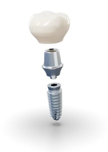 Implantátum, felépítmény és korona