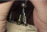 Implantátumos felépítmények frézelése a modellen